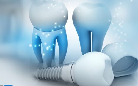 Dental Crowns vs. Dental Implants