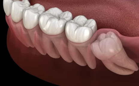 Wisdom Tooth