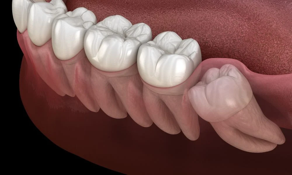 Wisdom Tooth